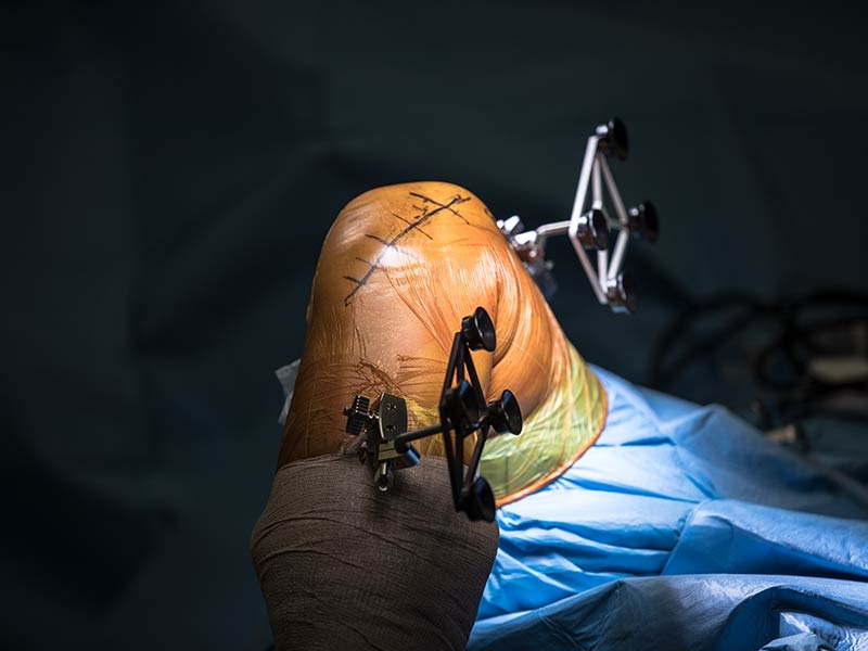 Robotik Total Diz Protezi Ameliyatı